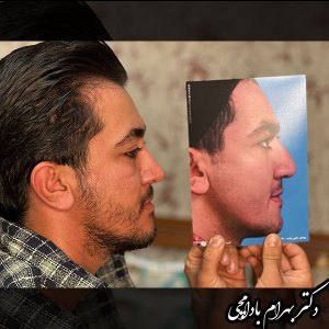 جراحی-بینی-03