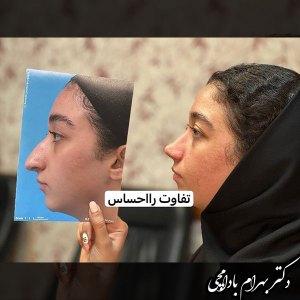 جراحی-بینی-04