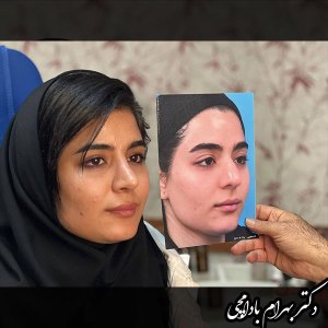 جراحی-بینی-07