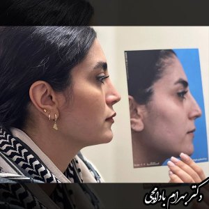جراحی-بینی-11