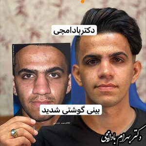 جراحی-بینی-12