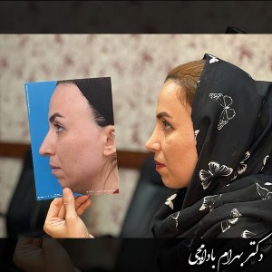 جراحی-بینی-13
