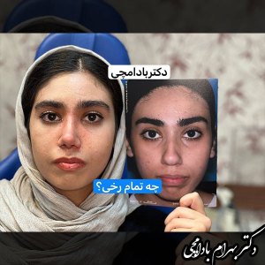 جراحی-بینی-14