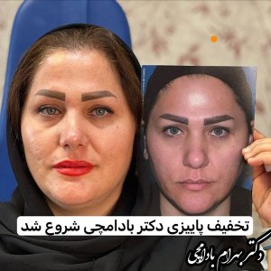 جراحی-بینی-15