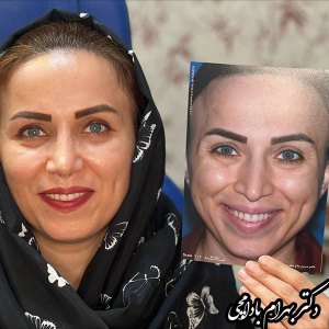 جراحی-بینی-16
