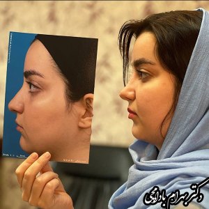 جراحی-بینی-17