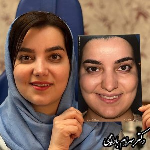 جراحی-بینی-18