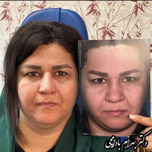 جراحی-بینی-20
