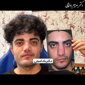 جراحی-بینی-21