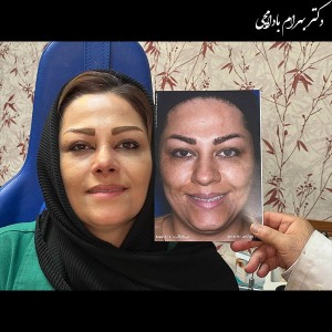 جراحی-بینی-23