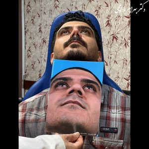 جراحی-بینی-24