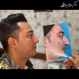 جراحی-بینی-26
