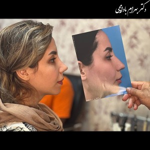 جراحی-بینی-28