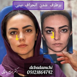 جراحی-بینی-30