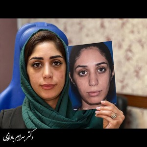 جراحی-بینی-32