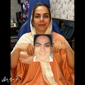 جراحی-بینی-33