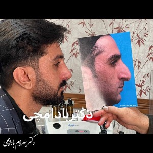 جراحی-بینی-35