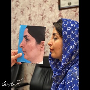 جراحی-بینی-36