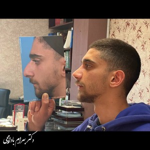 جراحی-بینی-38