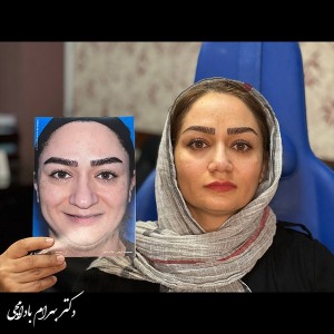 جراحی-بینی-39