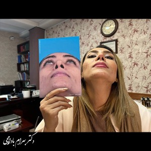 جراحی-بینی-42