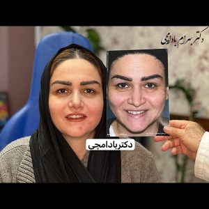جراحی-بینی-51
