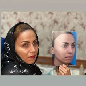 جراحی-بینی-57