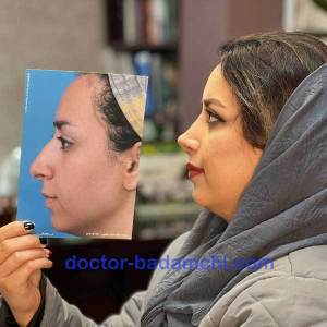 جراحی-بینی-59