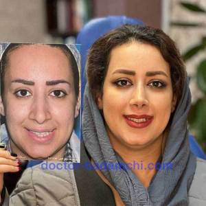 جراحی-بینی-60