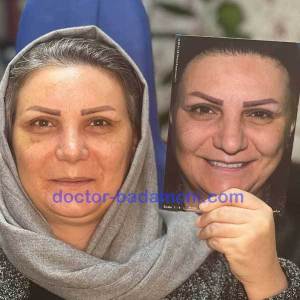 جراحی-بینی-64