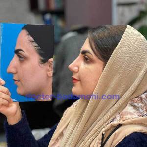 جراحی-بینی-69