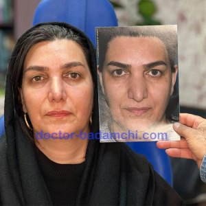 جراحی-بینی-71