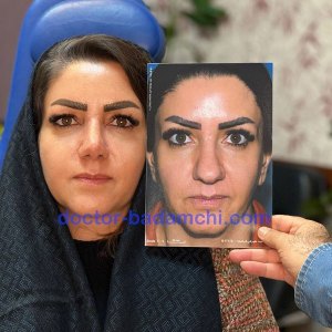 جراحی-بینی-72