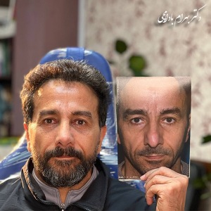 جراحی-بینی-75
