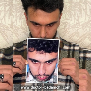 rhinoplasty-100