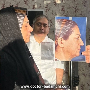 rhinoplasty-103