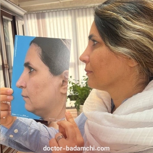 rhinoplasty-105