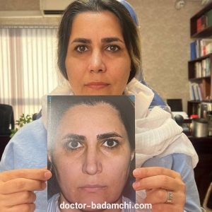 rhinoplasty-106