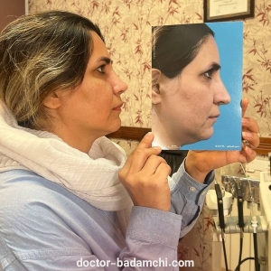 rhinoplasty-107