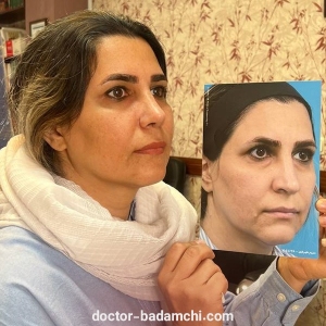 rhinoplasty-108