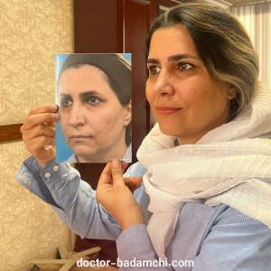 rhinoplasty-109