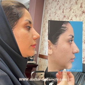 rhinoplasty-110