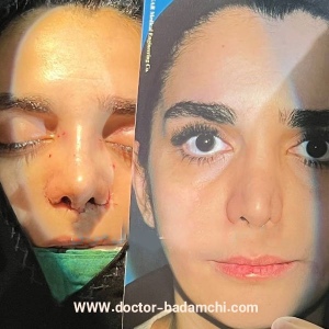 rhinoplasty-111