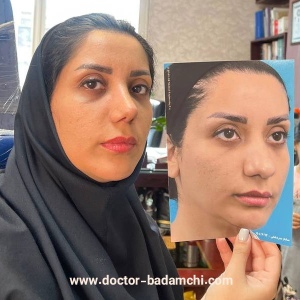 rhinoplasty-112