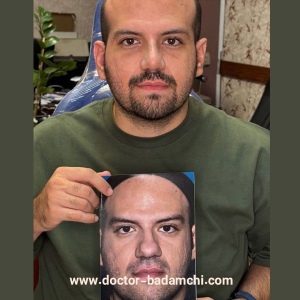 rhinoplasty-113