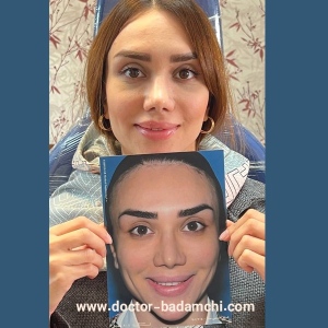 rhinoplasty-114
