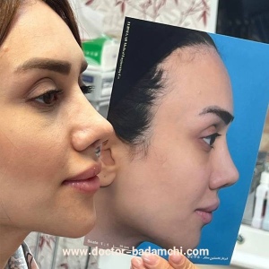 rhinoplasty-115