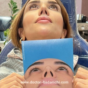 rhinoplasty-116