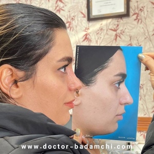 rhinoplasty-117