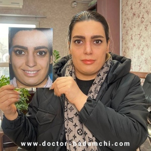 rhinoplasty-118